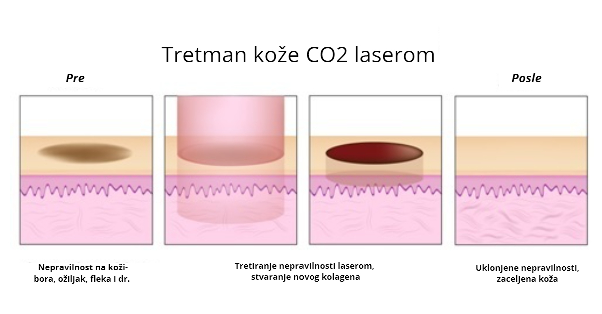 tretman kože laserom