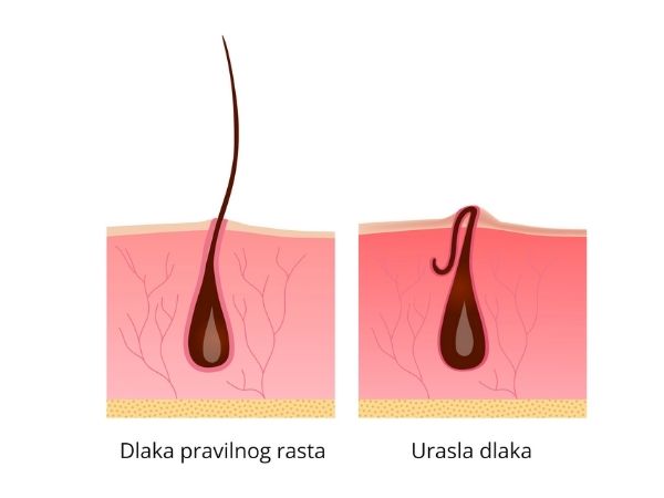 urasle dlake