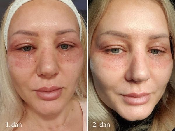 Eyelid correction with laser