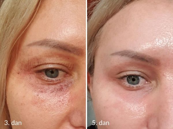 Eyelid correction laser recovery