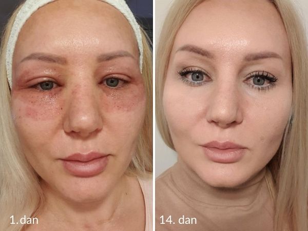 Eyelid correction with laser