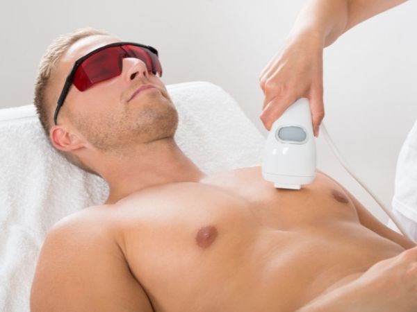 laser epilation men