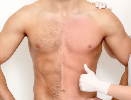 Laser epilation for men