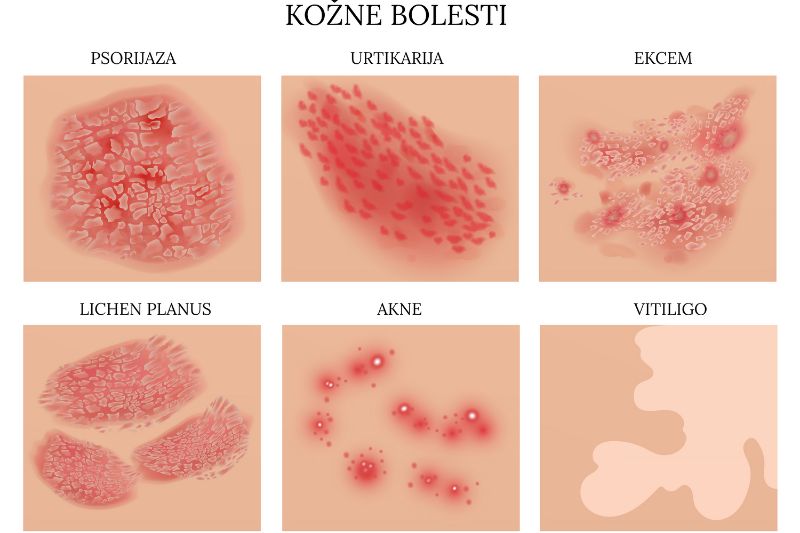 Kožne bolesti dermatolog beograd