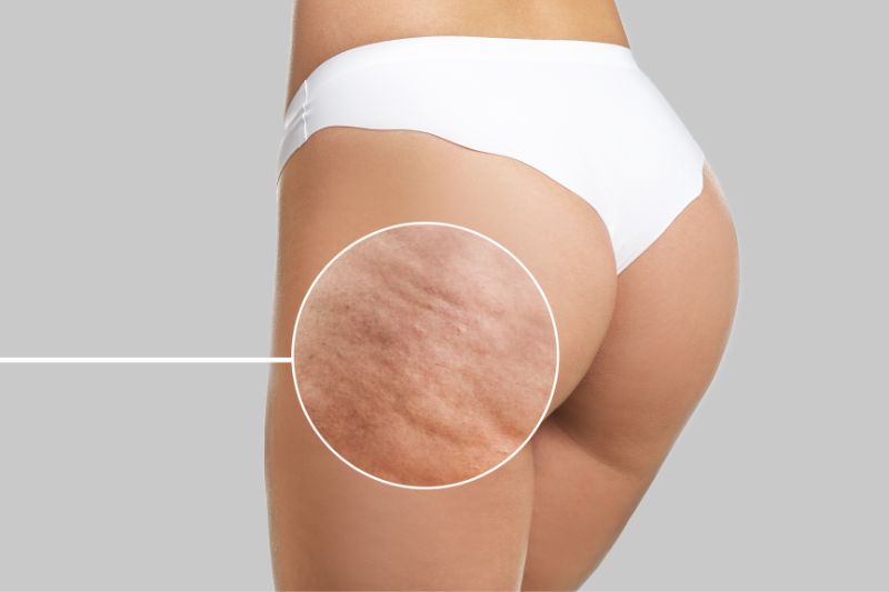 cellulite anticellulite